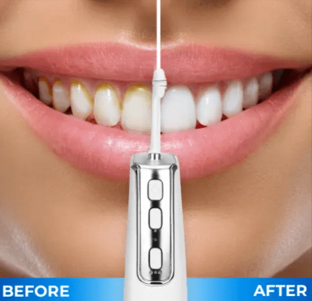 Miracle Smile Magic Flosser Result