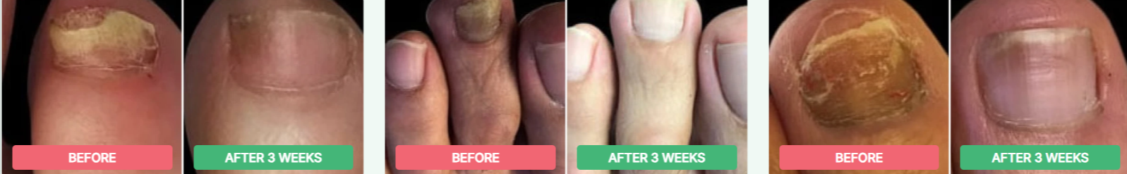 Dermafix Nail Fungus Treatment Gel Customer Reviews